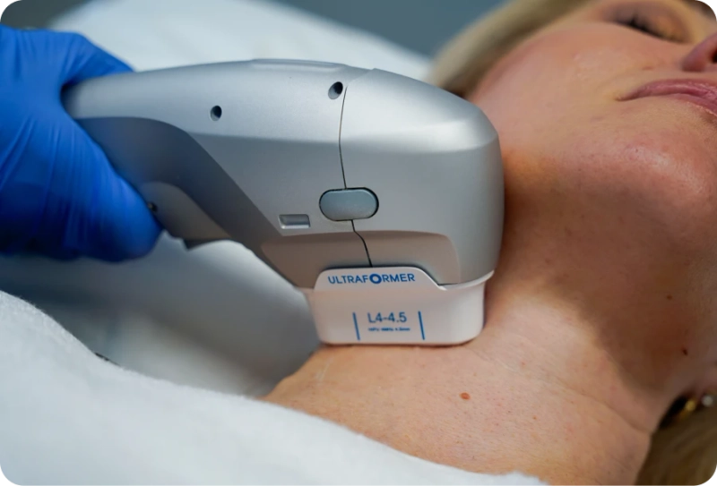 Is HIFU Treatment a Revolutionary Choice for Youthful Skin Look