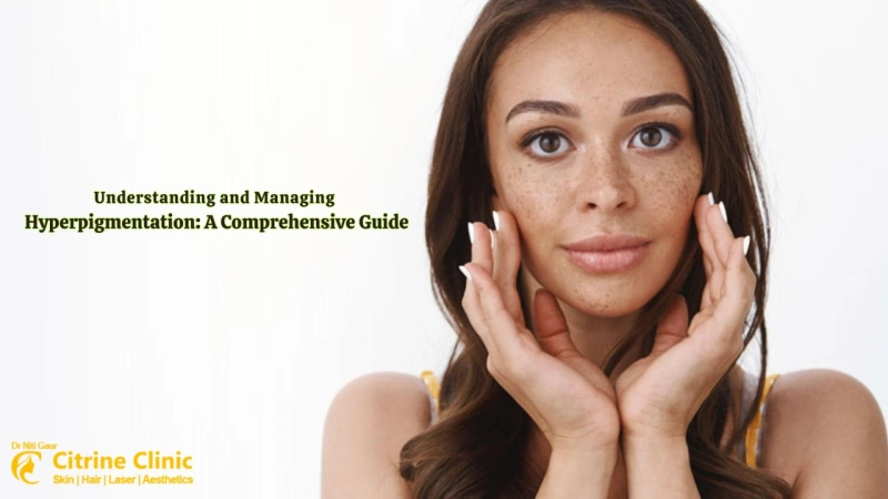 Understanding and Managing Hyperpigmentation: A Comprehensive Guide