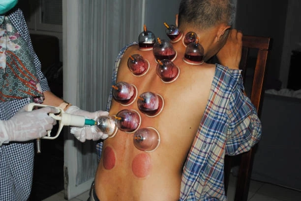 Elevate Your Health Routine with Cupping Treatment in Riyadh