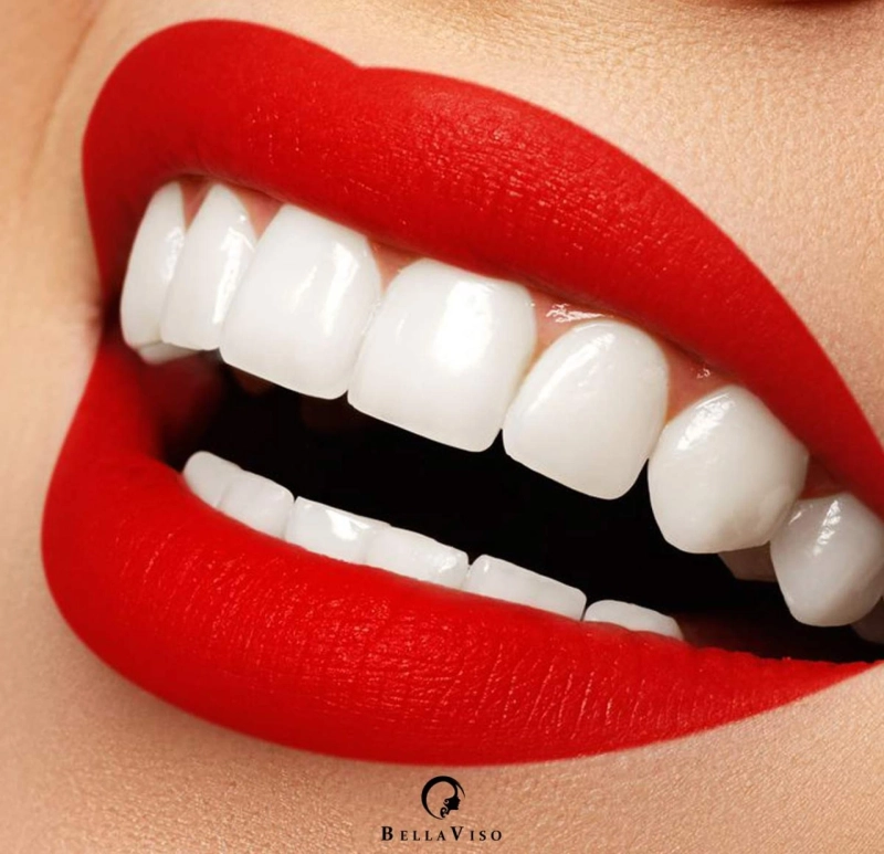 Dubai's Dazzling Smiles: Unveiling the Best Medical Centers for Dental Veneers in Dubai