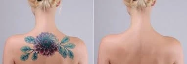 Dubai Laser Tattoo Removal for a More Confident You