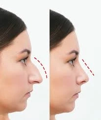 Is rhinoplasty in Riyadh painful? A detailed answer.