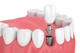 Dental Implants: The Bridge to a Confident, Functional Smile