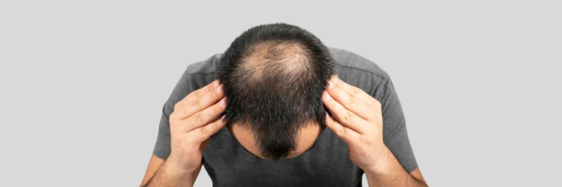 Have a Head Full of Hair with Hair Transplant