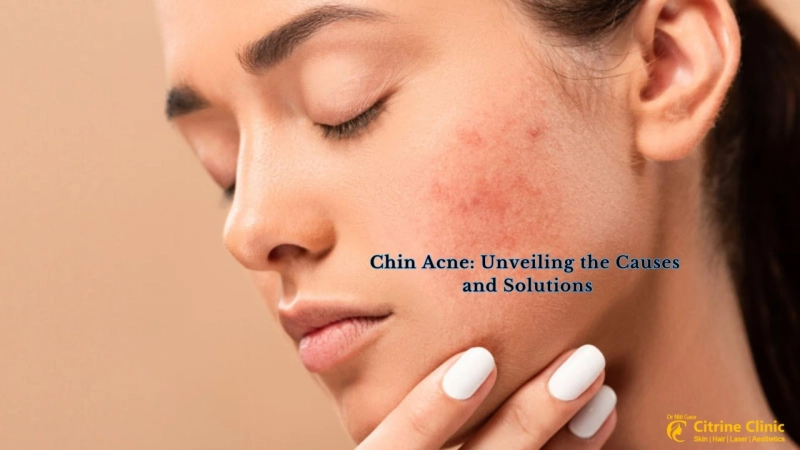 Chin Acne: Unveiling the Causes and Solutions