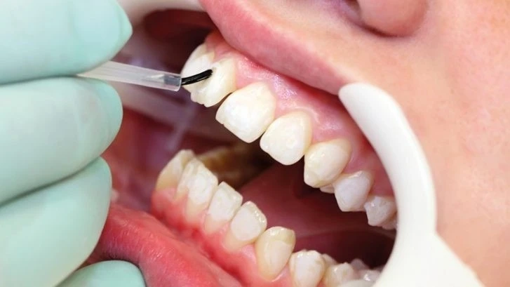 The Role of Composite Bonding in Cosmetic Dentistry