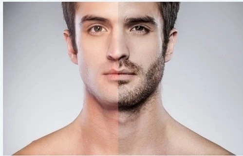 Understanding Beard and Moustache Transplant Techniques