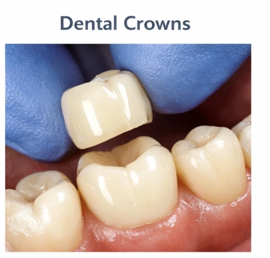 Do You Need a Crown After a Root Canal?
