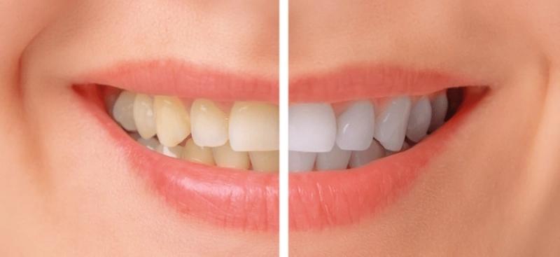 How much important is Dental Cleaning in Three Rivers for your health?