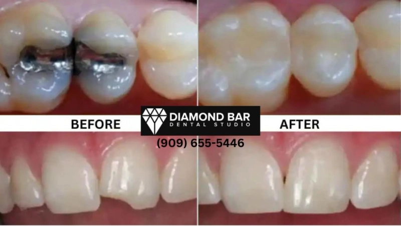 A Complete Guide for Patients Searching “Teeth Whitening Services Near Me”