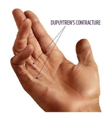 How common is Dupuytren’s Contracture, and why do people get it?