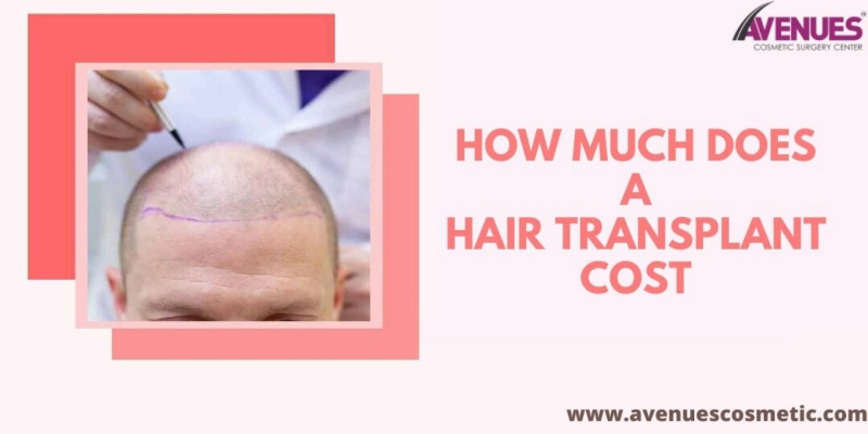 How Much Does a Hair Transplant Cost in Ahmedabad?