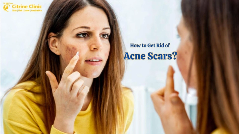 How to Get Rid of Acne Scars?