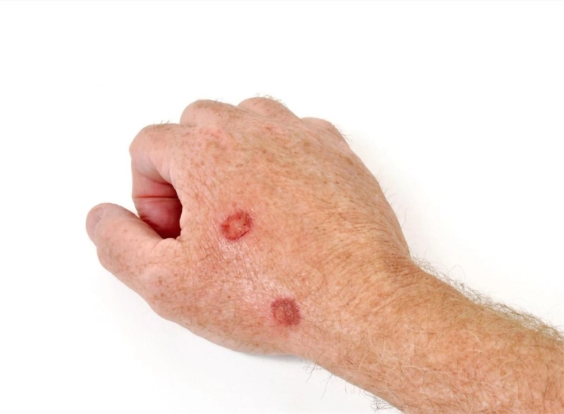 Imiquimod Cream: A Patient's Guide to This Topical Medication