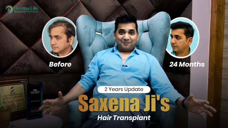 Hair Transplant for Advanced Baldness: Is It Still Possible?