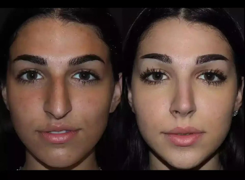 Septoplasty in Dubai: Standards in Septal Reconstruction