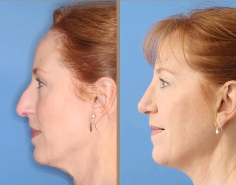 Rhinoplasty Surgery: A Complete Guide for a Confident New Look