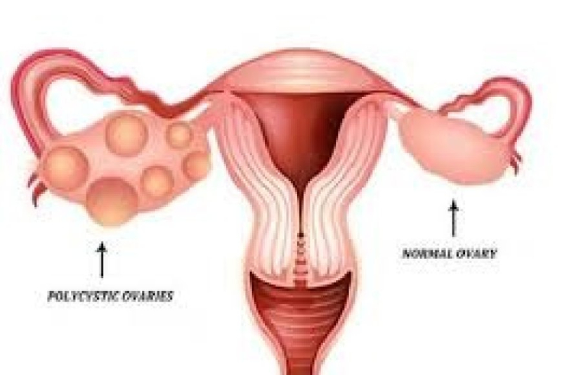 *Empowering Wellness: Discovering the Best Gynecologist for PCOD