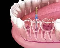 Expert Root Canal Treatment in Abu Dhabi: Your Dental Solution