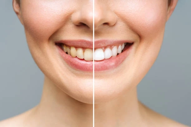 The Best Teeth Whitening Products Available in Riyadh