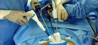Bariatric (Obesity) Surgical Devices Market Growth Factors, Regional Analysis, Applications, & Manuf