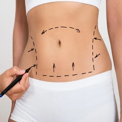 What is the difference between traditional liposuction vs Vaser liposuction?