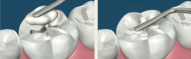 No More Metal Mouth The Rise of Natural-Looking Fillings