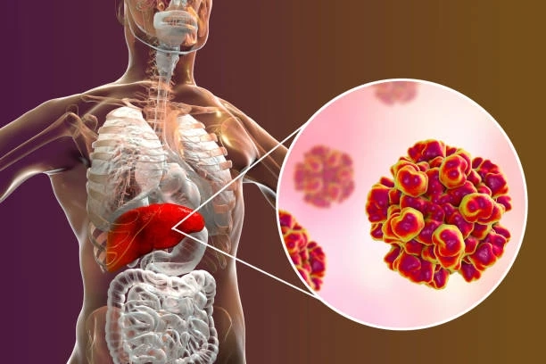 Autoimmune Hepatitis: Causes, Symptoms, Diagnosis, and Treatment