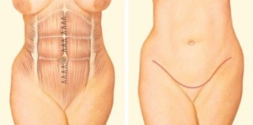 What is the Cost of Tummy Tuck Surgery in India?