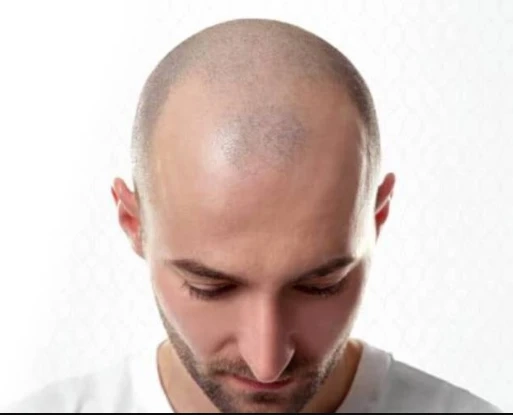 All You Need to Know About Robotic Hair Transplant