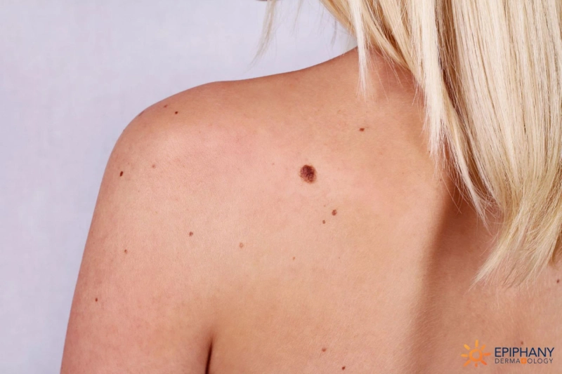 Dubai's Advanced Warts Removal Techniques