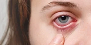 Eye Infection: Types, Symptoms, Causes & Treatment