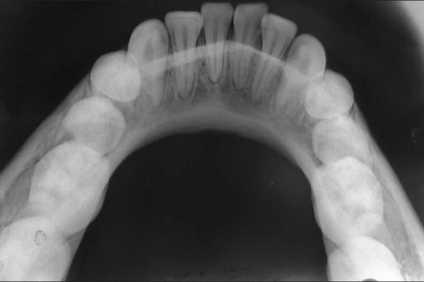 Is a Panoramic X-ray Worth the Cost in Dubai?