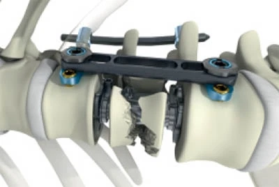 Global Spinal Implants Market 2021 Analysis, Types, Applications, Forecast and COVID-19 Impact Analy