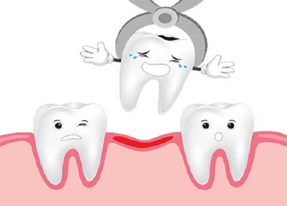 Why did Removing my Wisdom Teeth Cause Neck Pain?
