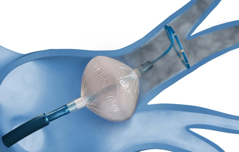 Cryoablation Devices vs. Radiofrequency Ablation: Which is Better for Treating Liver Cancer?