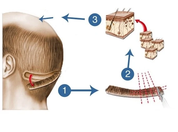 Explain the cost and success rate of FUT hair transplant method