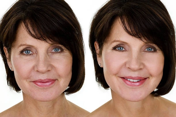 Best Treatment for Deep Wrinkles on Face and How to Remove