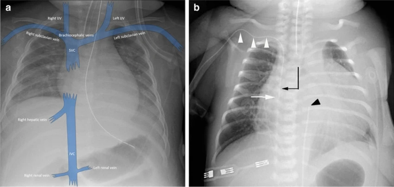 Central Venous Catheter (CVC) Are Long, Flexible Tubes Inserted Into Veins In Your Neck, Chest, Arm Or Groin By Your Provider
