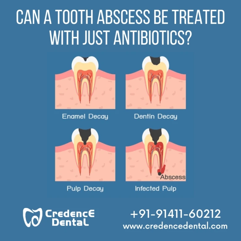 Can a Tooth Abscess be Treated with just Antibiotics?