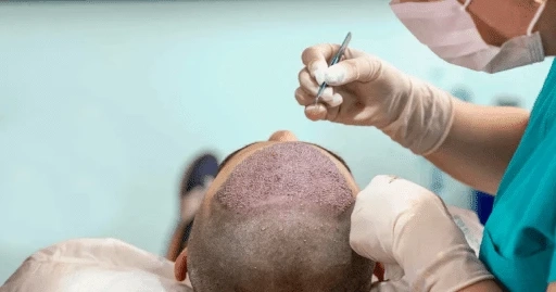 Hair Transplant Surgery's Financial Viability: Is it a Worthy Investment?