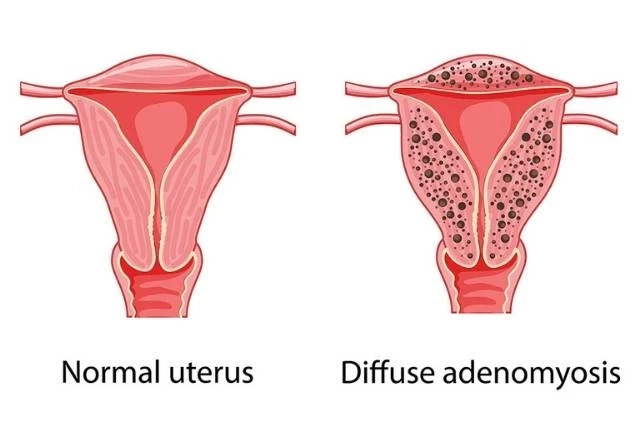 Cracking the Code: Understanding Adenomyosis Symptoms | DLI