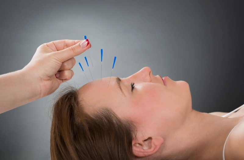 How Acupuncture Helps Relieve Migraine Pain Naturally
