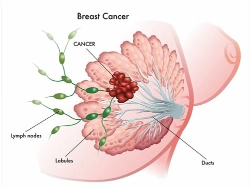 Study on PDX Model of Human Breast Cancer