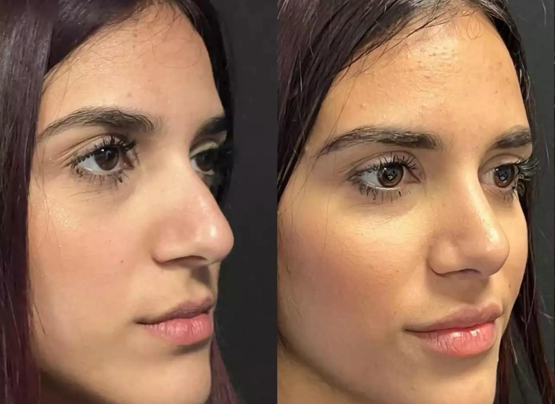 Septoplasty in Dubai: What Makes It a Global Medical Destination?