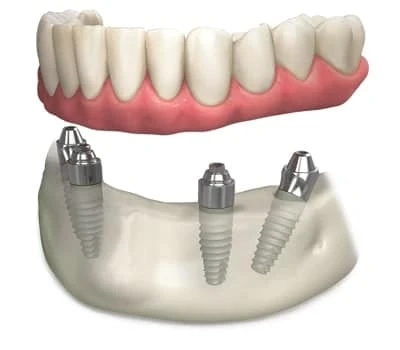 Which Are The Factors To Verify Before Teeth Replacement?