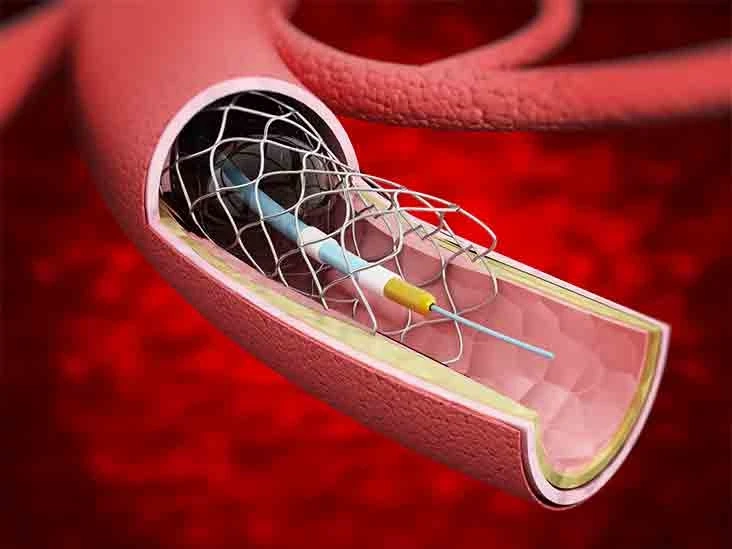 Vascular Stents Market Research Report- Forecast till 2027