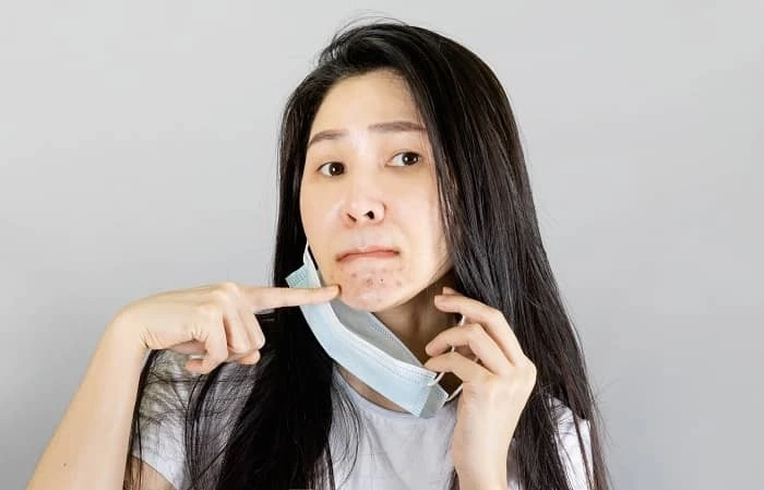 Does Calamine Help In Aiding Pimples? Here’s the Answer