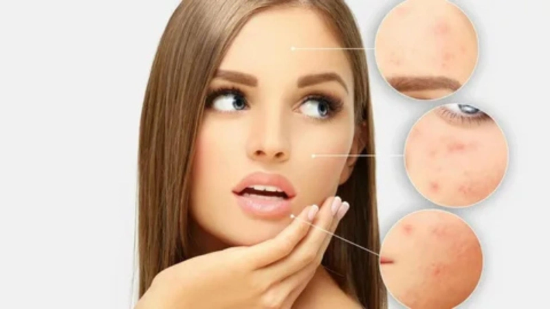 Acne Scars Treatment in Delhi: Best Solutions for Clear & Smooth Skin