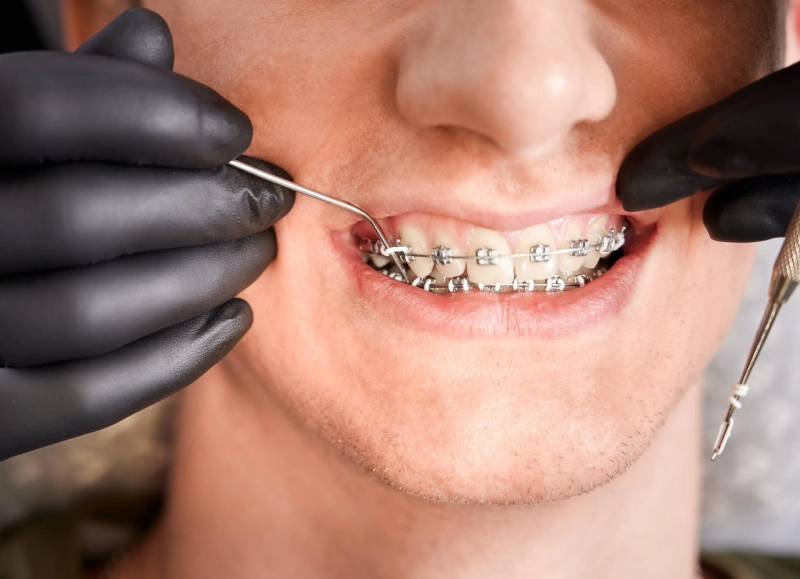 Achieve a Beautiful Smile with the Best Orthodontist in South Charlotte